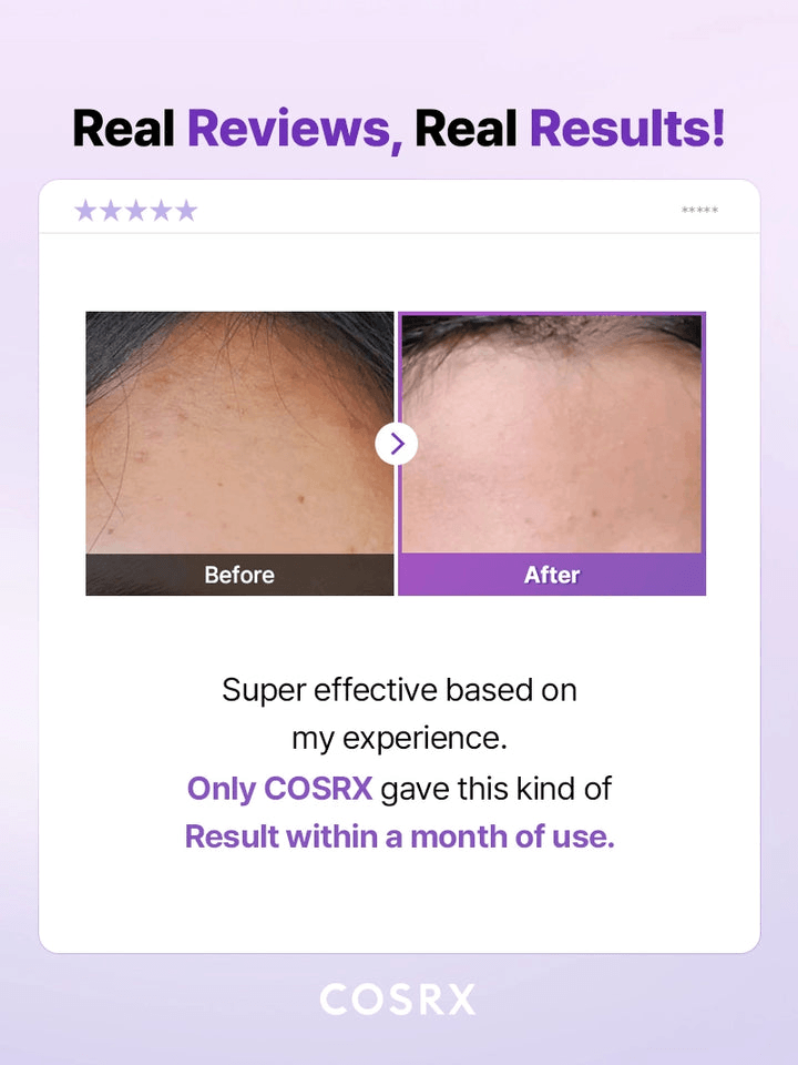 Before and after results using COSRX AHA/BHA Clarifying Treatment Toner | Korean Toners, showcasing effective skin improvement.