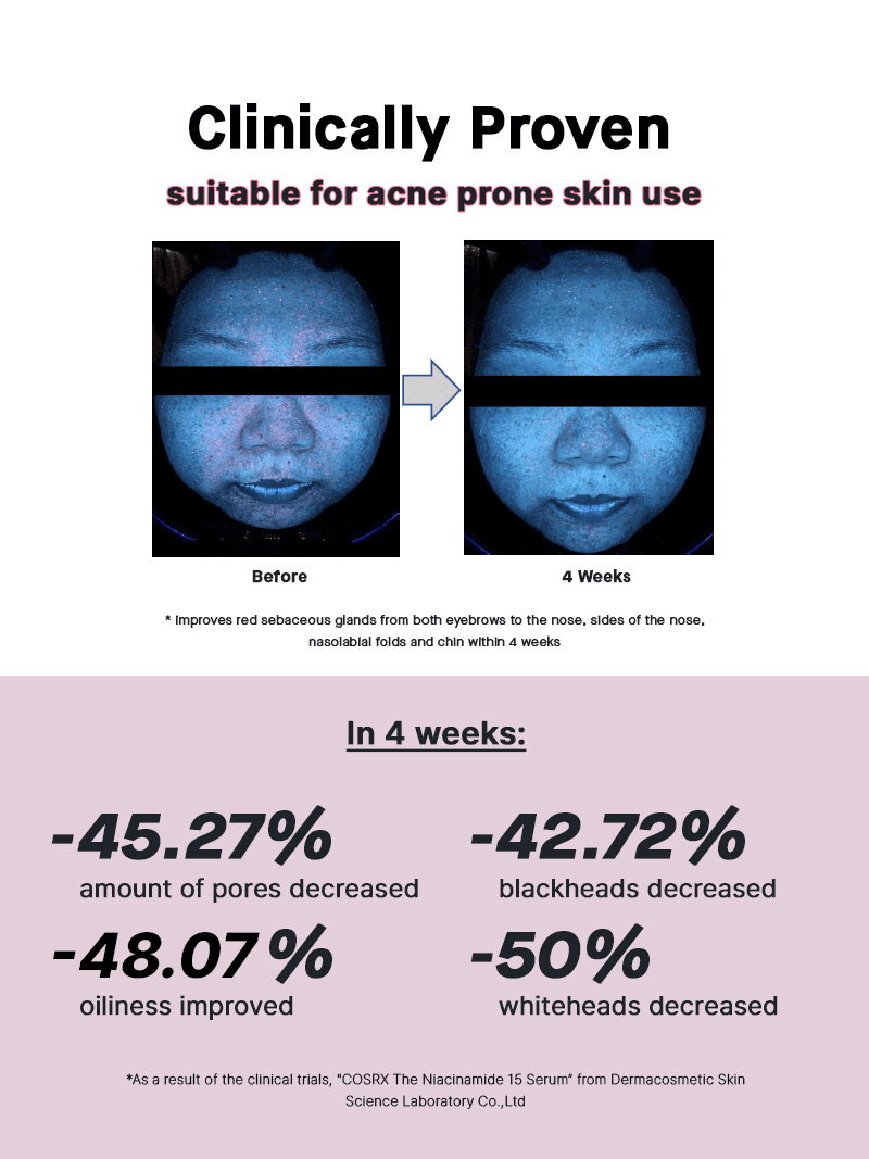 Before and after results demonstrating COSRX The Niacinamide 15 Serum's effectiveness for acne-prone skin in 4 weeks.