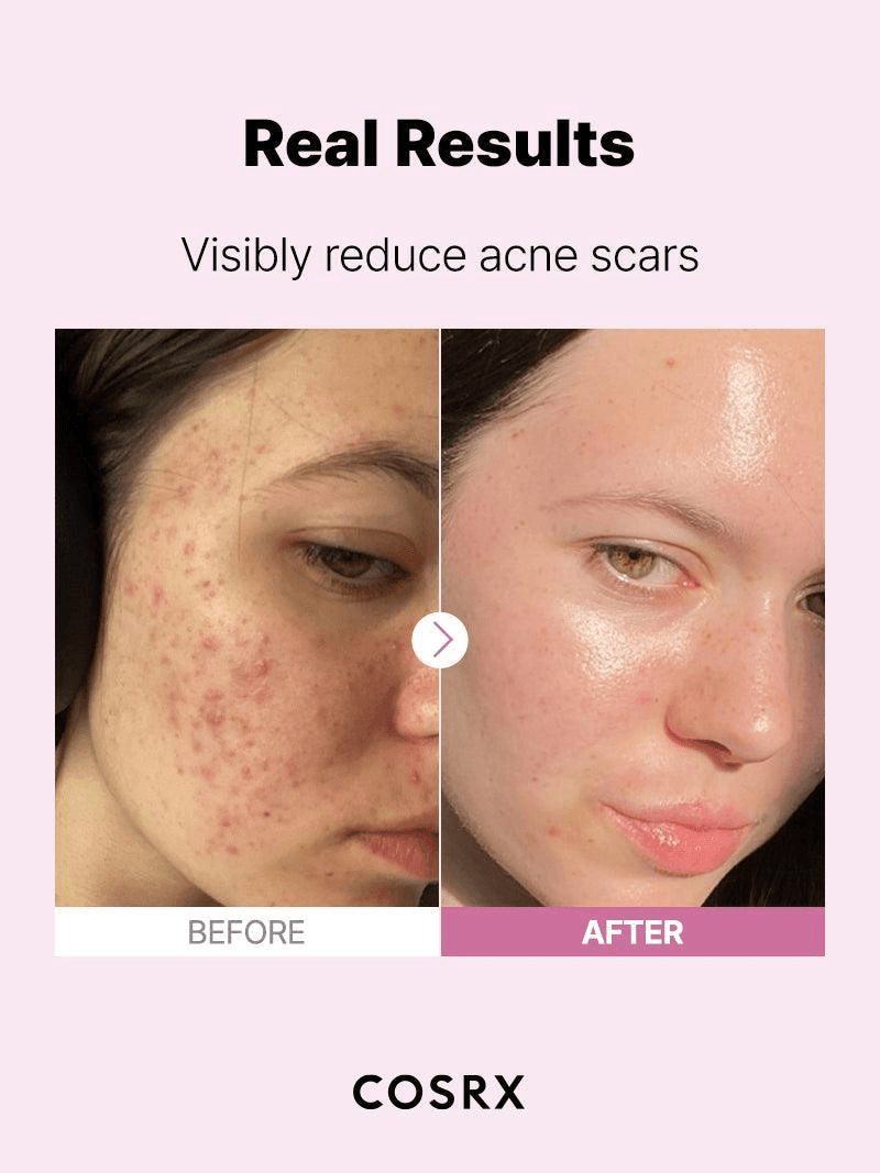 Before and after showing real results of COSRX The Niacinamide 15 Serum in visibly reducing acne scars.