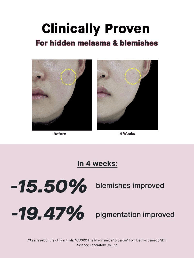 COSRX The Niacinamide 15 Serum results showing improvement in melasma and blemishes after 4 weeks treatment.
