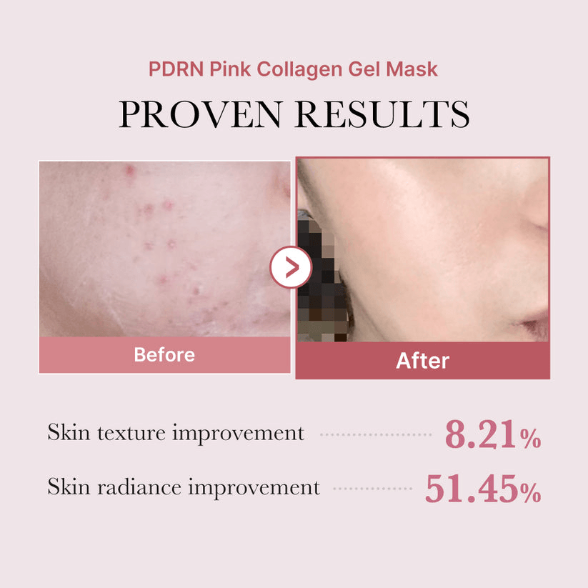 Before and after results of Medicube Salmon PDRN Pink Collagen Jelly Gel Mask showing skin improvement.